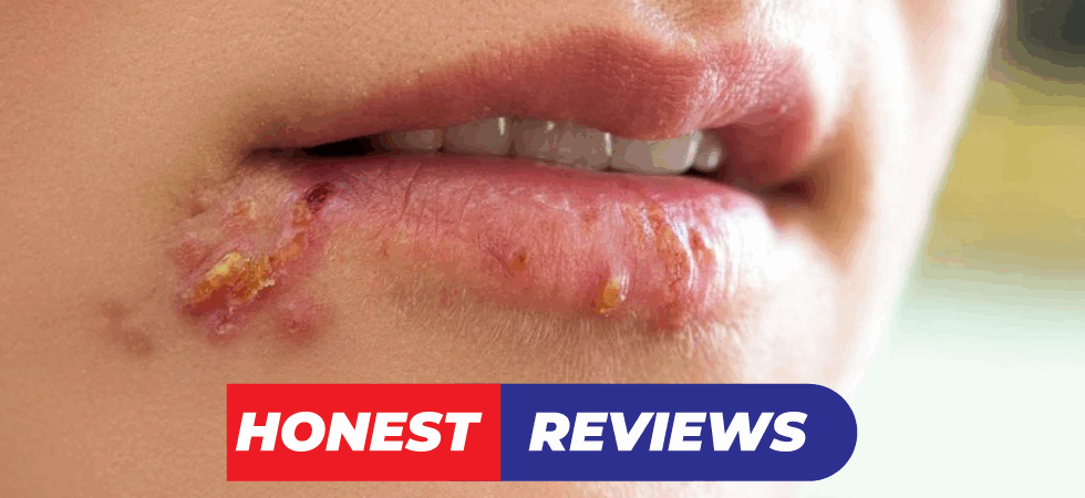 Eliminate Herpes
